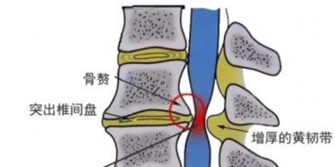 不是所有的颈椎病人都能按摩？